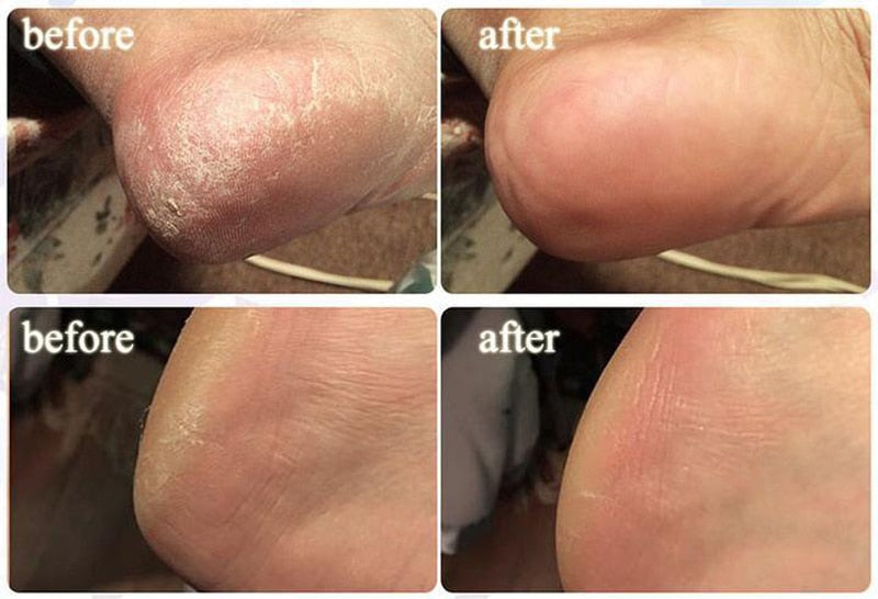 Anti-Swelling Foot SPA Ginger Foot Soak Effervescent